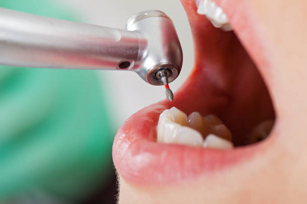 Best Knocked-Out Tooth (Avulsed Tooth) Treatment in Vandergrift, PA